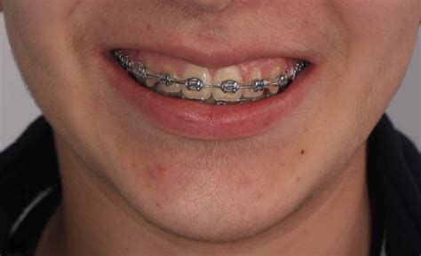 precio tratamiento brackets metalicos|precio de brackets dentales.